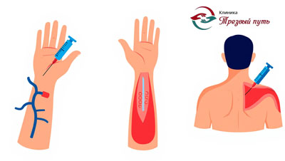 Инфографика по способам введения препарата